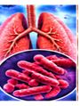 Respiratory Infections
